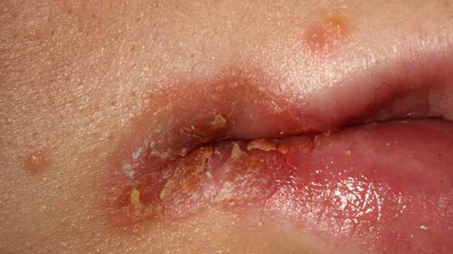 کی‌لیت گوشه لب (Angular Cheilitis)