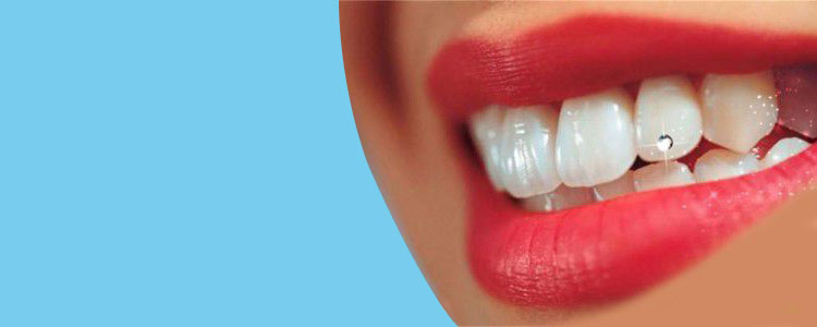 نگین دندان چیست؟
