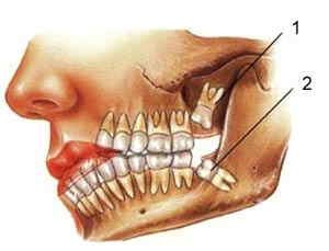 عوارض جراحی دندان عقل