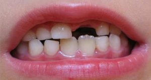 دندان قروچه کودکان
