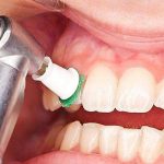 آسیب جرم گیری به دندان