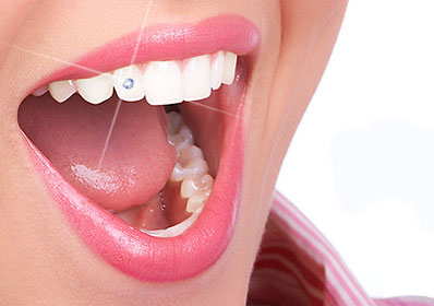 انواع نگین دندان