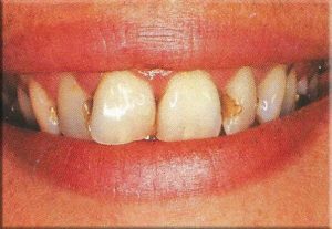 مراقبت های بعد از جرم گیری دندان