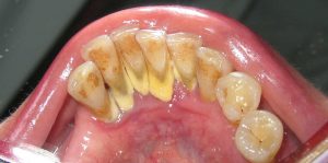 مراحل جرم گیری دندان