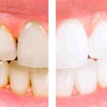 5 عامل زردی دندان