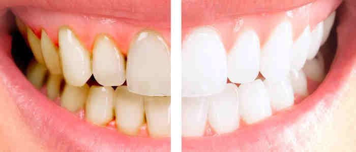 ۵ عامل مهم تغییر رنگ و زردی دندان