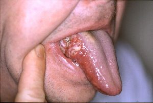 نشانه های سرطان دهان