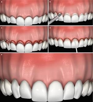 مزایای تاج زدن دندان چیست؟